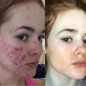 acne treatment cream
